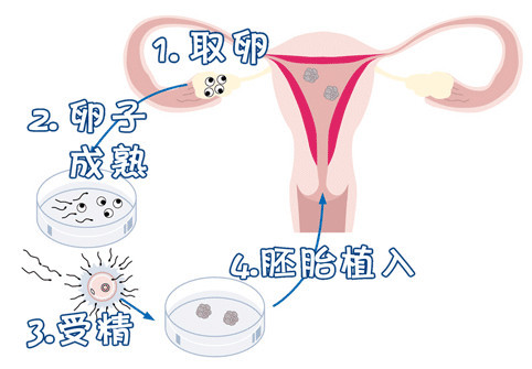 人工孕妈供卵服务怎么预约